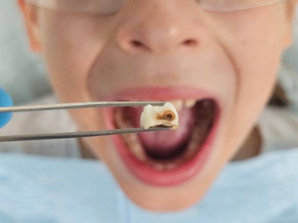 Best Emergency Treatment for Toothache in Luverne, AL